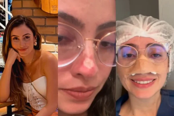 Juliana Vilela teve sarcoma, câncer no nariz, e mostra seu processo de recuperação em fotos - Metrópoles