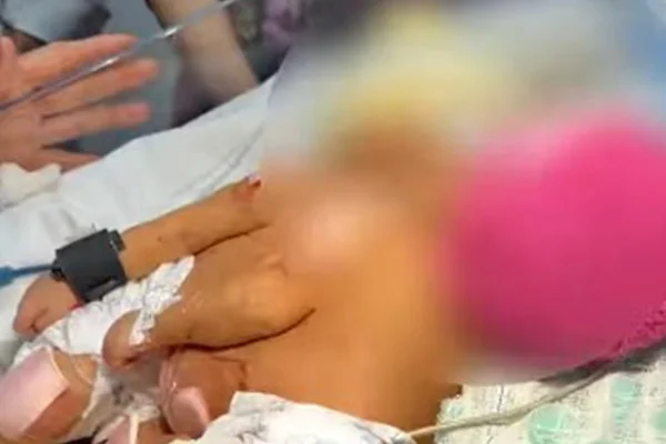 Gêmeas siamesas nascem no Hmib e família avalia cirurgia de separação