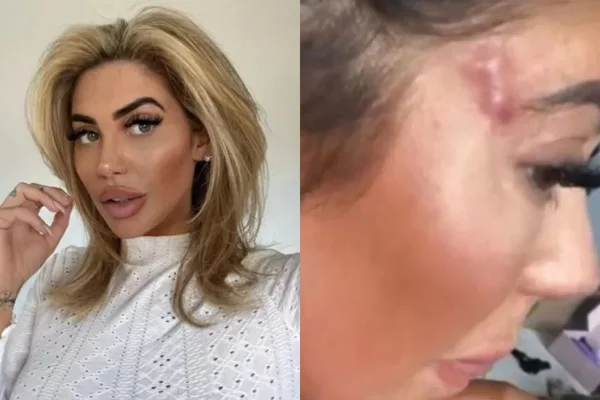Estrela de reality fica com cicatriz no rosto após erro em cirurgia