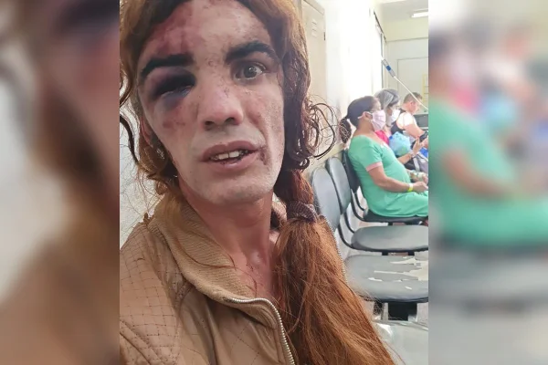 Mulher trans é espancada por homem no DF e mostra rosto desfigurado