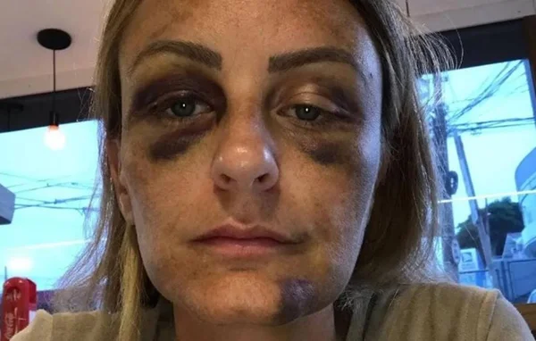 Imagem colorida de Carolina Braga, agredida pelo surfista João Paulo Azevedo