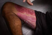 Marcas dos enxertos de pele podem ser vistas nas pernas de Gustavo. Um dos enxertos não cicatrizou como esperado e pode exigir uma nova cirurgia.