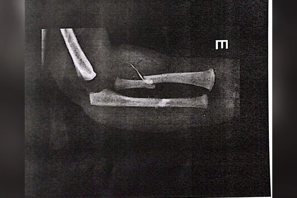 Bebê é levada ao hospital com ossos quebrados e pais são presos - imagem 2 Bebê é levada ao hospital com ossos quebrados e pais são presos - imagem 2