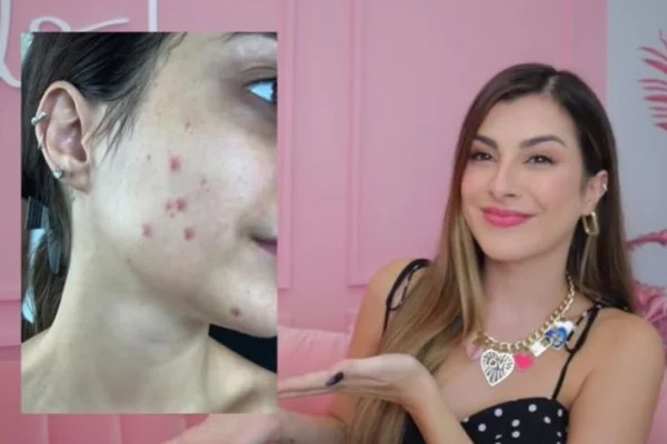 Veja as famosas que tiveram resultados negativos com “chip da beleza”