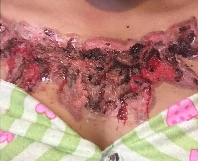 Garota relata momentos de dor ao remover tatuagem com método polêmico - imagem 4 Garota relata momentos de dor ao remover tatuagem com método polêmico - imagem 4