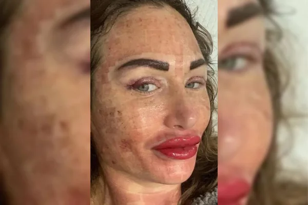 Mulher realiza três procedimentos em um dia e fica com rosto deformado