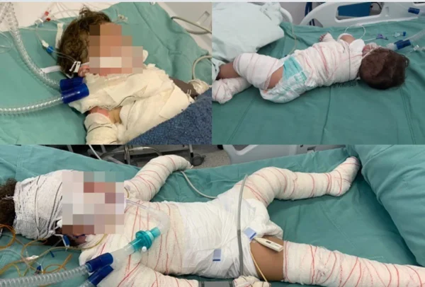 Imagem colorida de bebê que sofreu queimaduras após explosão de churrasqueira em Cuiabá (MT) - Metrópoles