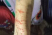 Foto das agressões no braço da vítima