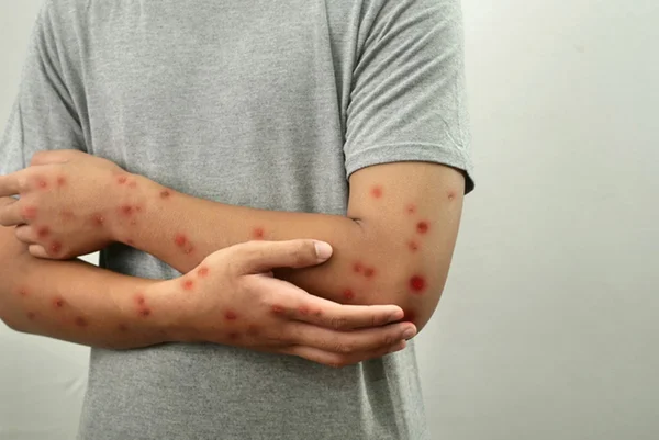 Foto colorida de homem com feridas de mpox nos braços - Metrópoles
