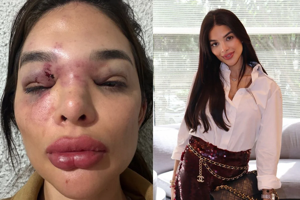 Giullia Kos expôs a agressão do marido nas redes sociais Giullia Kos expôs a agressão do marido nas redes sociais