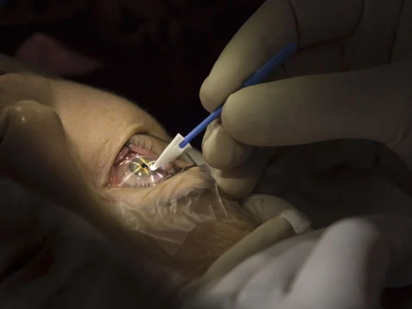 Foto colorida de cirurgia com laser em olho. Imagem ilustrativa - Metrópoles