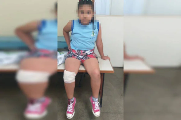 Foto colorida criança com perna enfaixada