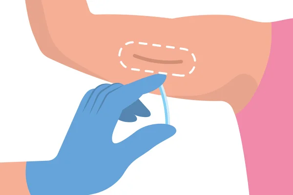 Ilustração colorida de implante contraceptivo hormonal (implanon) - Metrópoles