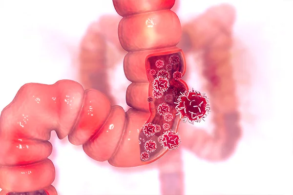 Câncer no intestino