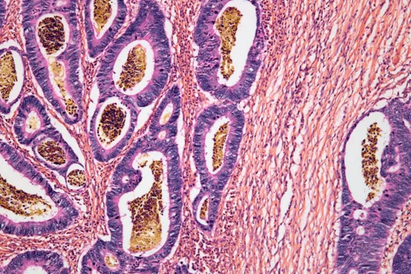 Bactéria da Amazônia pode combater câncer de intestino, diz Unicamp