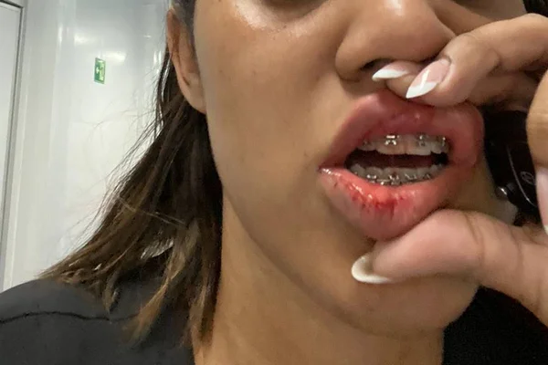Enfermeira com a boca ferida após soco