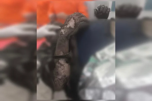Veja como trabalhador queimado após explosão chegou a hospital no DF