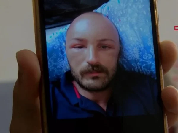 foto colorida de homem com inchaço na cabeça