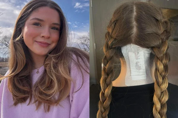 Colagem de fotos colorida de jovem sorrindo para foto ao lado esquerdo e ela de costas com curativo na cabeça ao lado direito - Metrópoles.