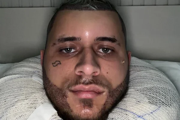 Saiba por que MC Pedrinho apareceu com rosto irreconhecível