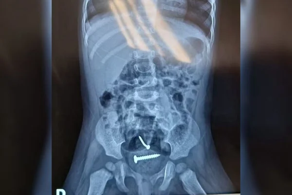 Imagem colorida de exame que mostra parafusos no corpo de menina - Metrópoles