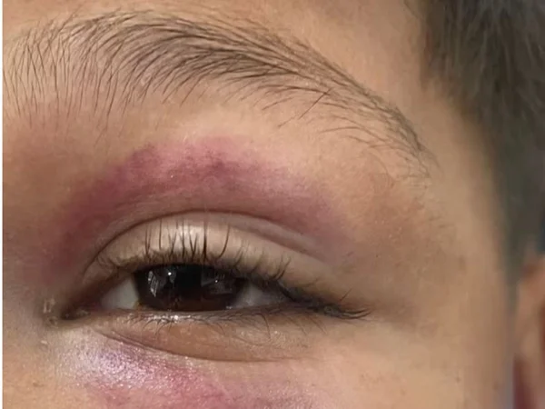 criança com olho ferido