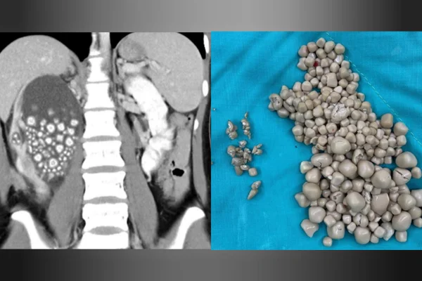 Montagem mostra as 300 pedras no tim encontradas em corpo de jovem taiwanesa