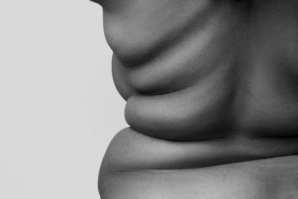 Foto em preto e branco de corpo feminino acima do peso - Metrópoles.