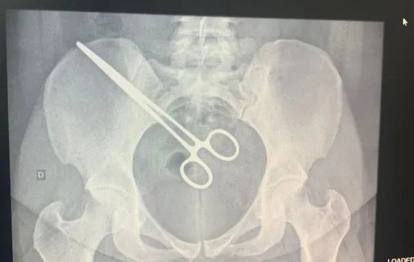 MULHER DESCOBRE PINÇA DENTRO DO CORPO AO VISITAR MARIDO PRESO - METRÓPOLES