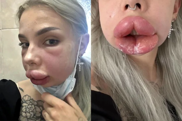 Jovem fica deformada após reação a procedimento labial: “Quase morri”