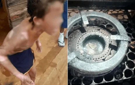 Criança que sofreu queimaduras ao tentar fazer comida é abandonada pela mãe