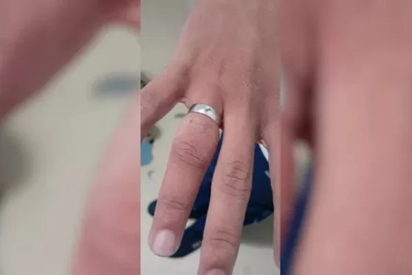 Aluno é socorrido após ficar 2h com aliança presa no dedo