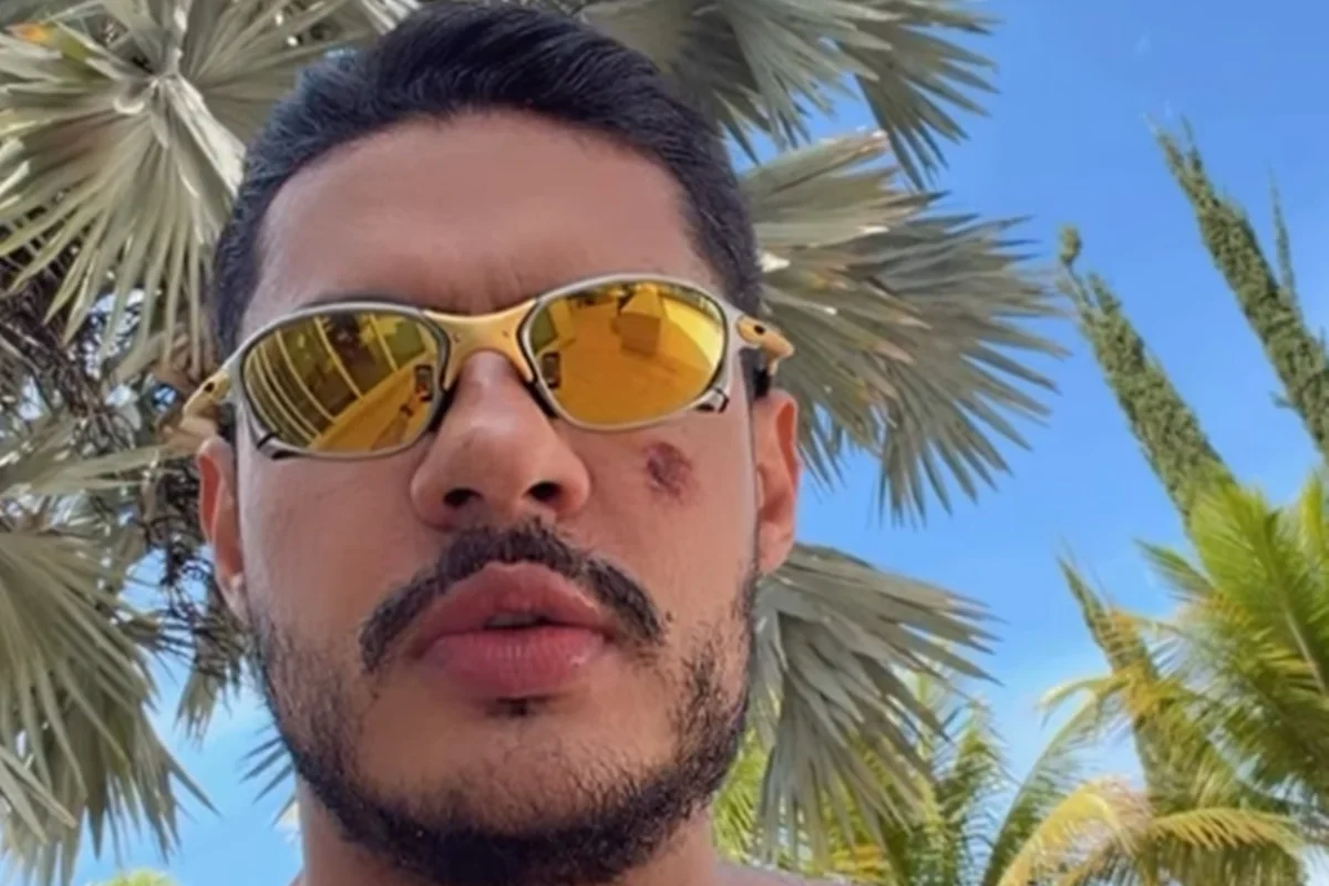 Hungria com o rosto machucado após cair de moto Hungria com o rosto machucado após cair de moto