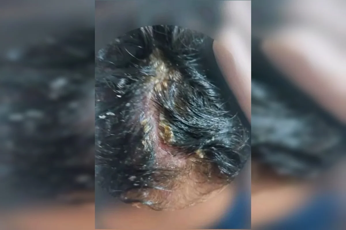 Couro cabeludo da criança com larvas Couro cabeludo da criança com larvas