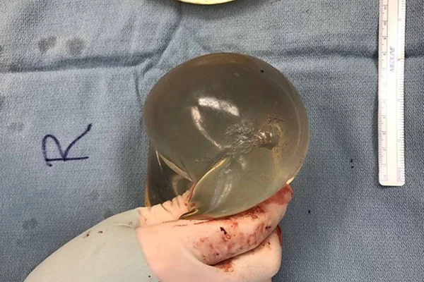 implante de silicone mostrando trajetória
