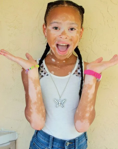 Menina de 10 anos com vitiligo supera o bullying e conquista o mundo da moda