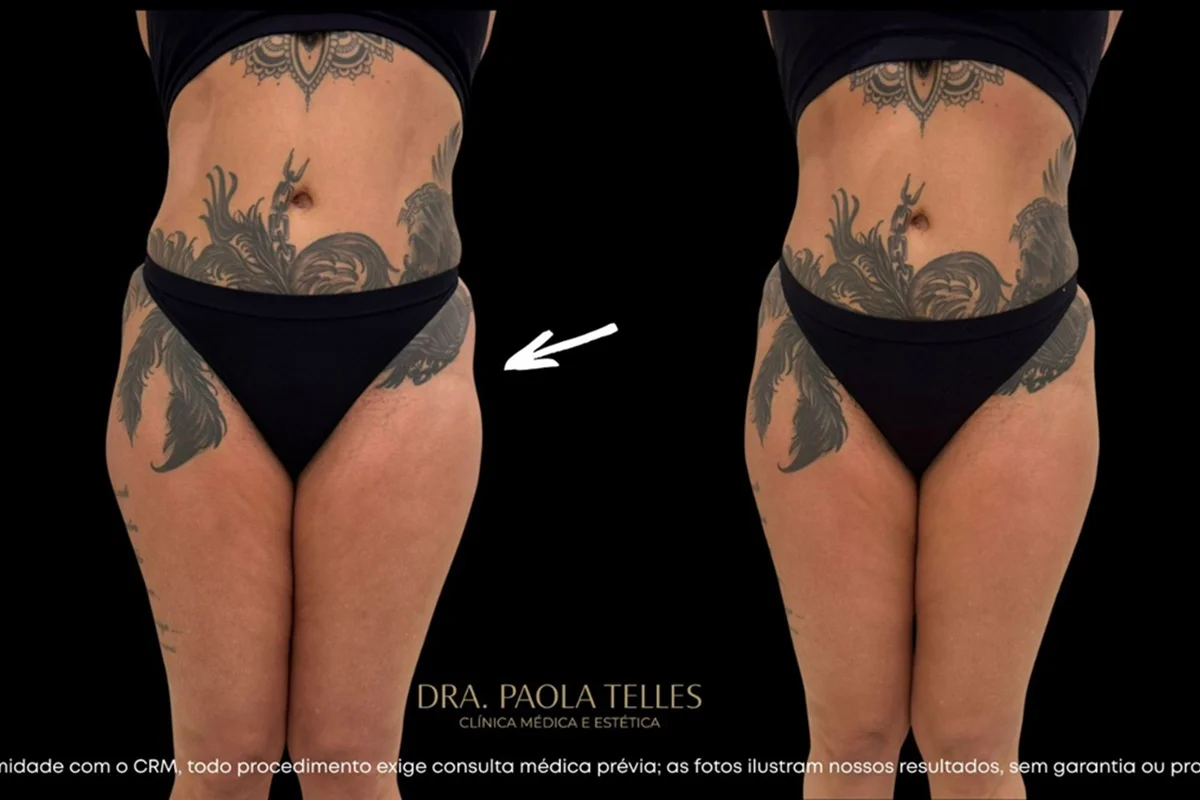 Antes e depois do bumbum da miss São Paulo, Valentina Miranda Antes e depois do bumbum da miss São Paulo, Valentina Miranda