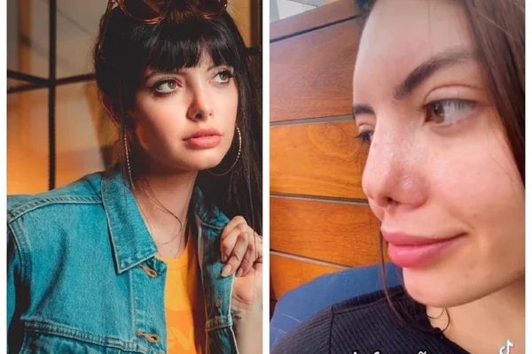 A modelo Sarah Cardoso - antes da cirurgia com Alan Landecker, à esquerda, e depois da cirurgia