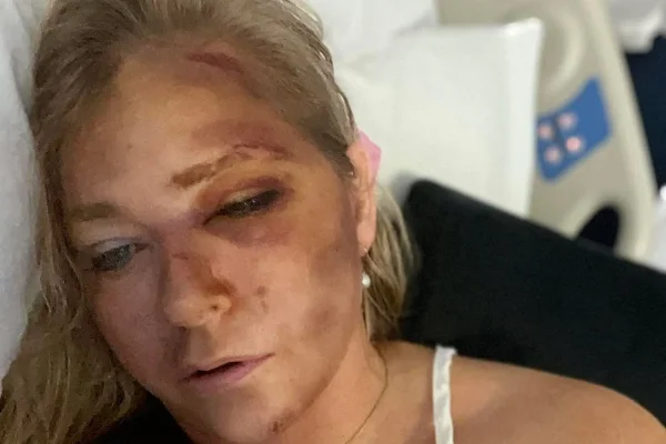 Foto colorida de mulher com hematomas no rosto - Metrópoles