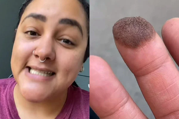 Colagem com fotos coloridas de uma mulher sorrindo e um dedo da mão machucado - Metrópoles
