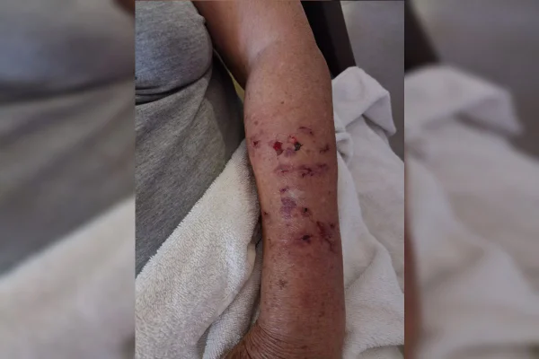 Garrafada e chute na cabeça: como idosa se livrou de ataque de cães