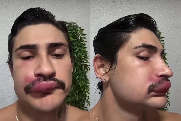 Willian Silva mostra como lábios ficaram inchados após espremer espinha. Metrópoles