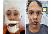 Thiago Medeiros passou por cirurgia após agressão