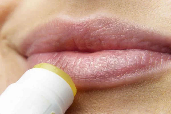 Protetor labial