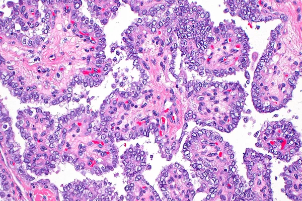 Imagem mostra visão de microscópio de um câncer na tireoide - Metrópoles