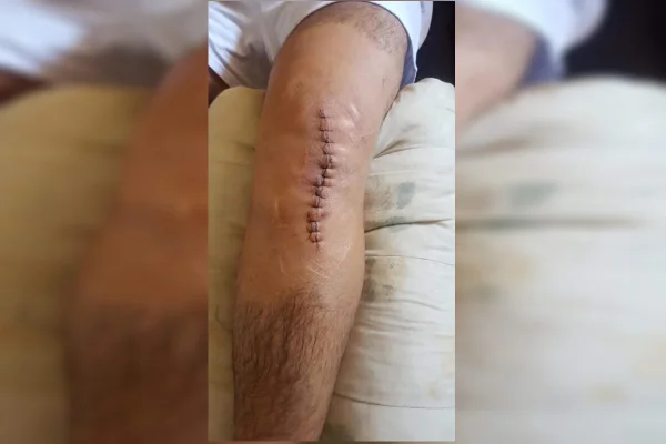 Justiça manda PMDF reintegrar sargento que quebrou joelhos em serviço