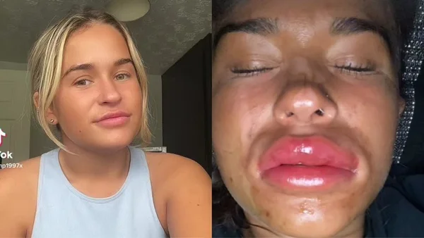 Influenciadora mostra rosto deformado após misturar botox e bebidas