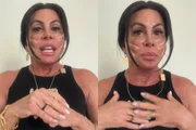 Gretchen aplica fios de sustentação no rosto; médicos explicam técnica Gretchen aplica fios de sustentação no rosto; médicos explicam técnica