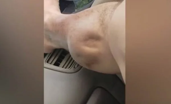 Com cãimbra, homem parece ter “alien” em panturrilha e assusta a web