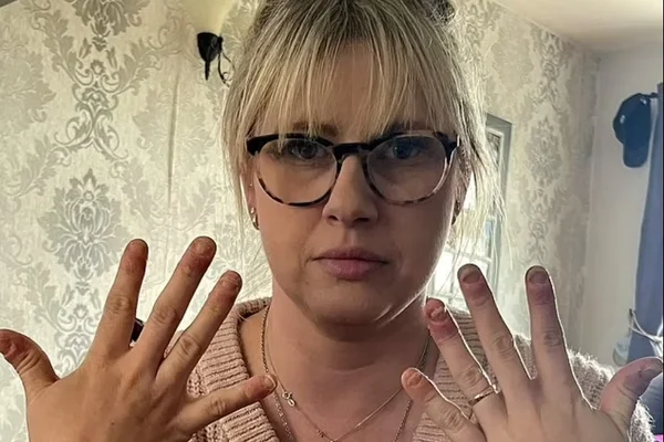 Imagem colorida: mulher mostra unhas após reação alérgica - Metrópoles